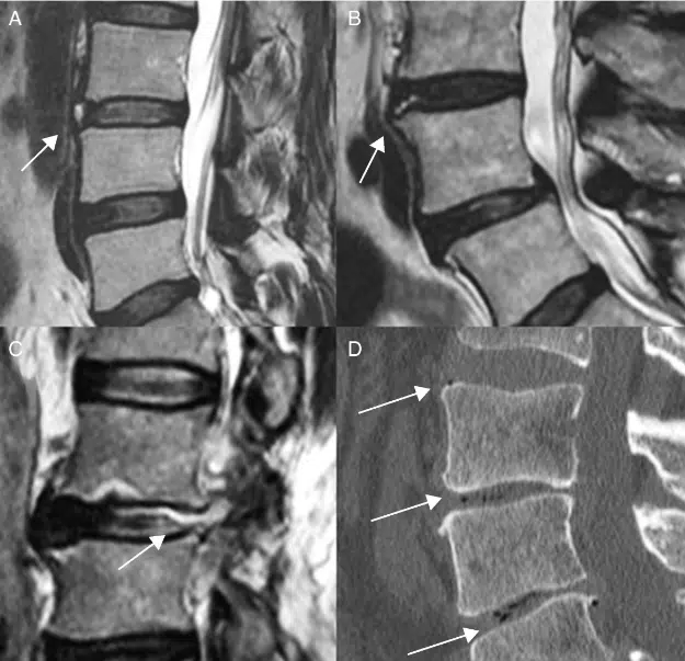 espondilolistesis patologica quiropractico