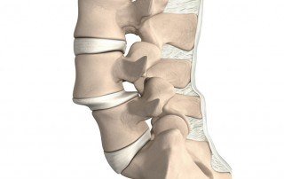 espondilolistesis quiropractico