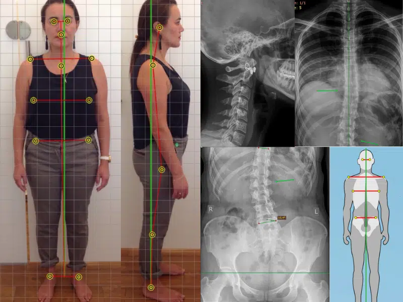 full-spine-radiografias-postura